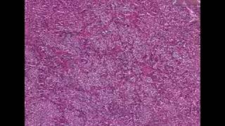 Histopathology PituitaryAcidophilic adenoma [upl. by Nylaret]