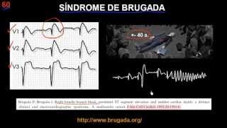 CURSO DE ELECTROCARDIOGRAFIA 60  SÍNDROME DE BRUGADA [upl. by Pacifa]