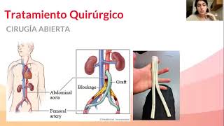 Arteriopatía Obstructiva Crónica de MMII P2 [upl. by Aicnetroh]