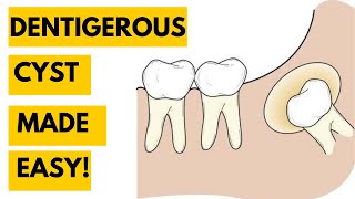 Dentigerous Cyst Clinical features Radiology Histology and Treatment [upl. by Cavan459]