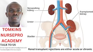 TYPES OF KIDNEY REJECTION [upl. by Nacnud]