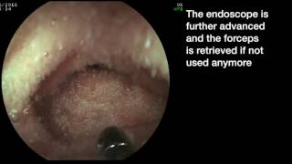 How to access a difficult ileocecal valve with a biopsy forceps [upl. by Yacov178]