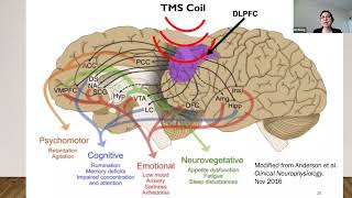 Transcranial Magnetic Stimulation for TreatmentResistant Depression [upl. by Yuh]