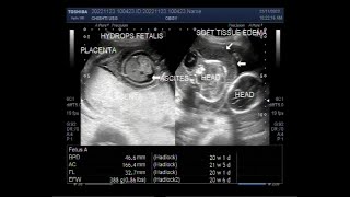 Twin Pregnancy of about 21 weeks with one fetus normal and the other with Hydrops Fetalis [upl. by Oiramed664]