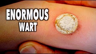 ENORMOUS WART vs LIQUID NITROGEN like seriously big  Dr Paul [upl. by Ahsiloc]