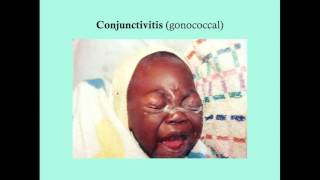 Conjunctivitis  CRASH Medical Review Series [upl. by Issiah452]