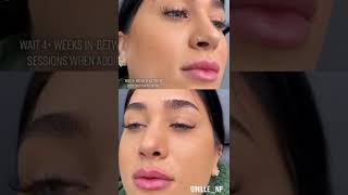 Lip injections before and after natural lip filler things to know after lip filler post care lips [upl. by Smaj819]