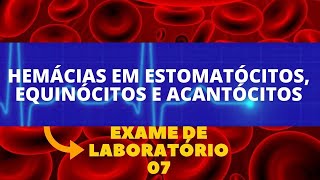 ESTOMATÓCITOS EQUINÓCITOS E ACANTÓCITOS  ALTERAÇÕES NO HEMOGRAMA HEMATOLOGIA [upl. by Salem587]