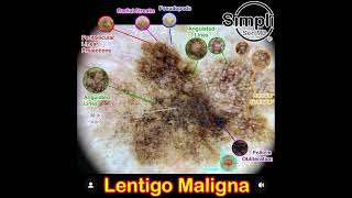 Lentigo Maligna Melanoma [upl. by Imailiv]