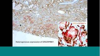 Elucidating tumor heterogeneity in prostate cancer by combined IHC amp novel RNA ISH [upl. by Udela57]