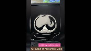 CECT Scan of Abdomen [upl. by Prader]