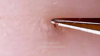 Ingrown hair removal under scab [upl. by Leoj]