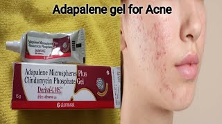 Adapalene gel Reviewin Telugu How much effective it is for Acneamp pimplesDeriva CMS gel [upl. by Dowski]