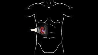 POCUS  Basic Renal Ultrasound [upl. by Martha]