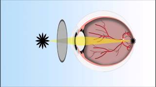 Presbyopia Explained Annimated Video [upl. by Ayhdnas481]