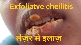 exfoliatve cheil और papilloma का लेज़र से इलाज़ कैसे होता है देखें by Dr CParyaMDS Dip in Laser [upl. by Yerffoj]