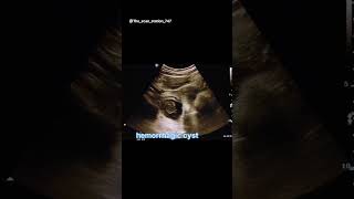 Hemorrhagic cystabdomen usg pediatrician doctor babydoctor ultrasound ultrasoundreport [upl. by Olathe916]