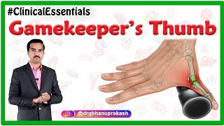 Gamekeeper’s thumb or skiers thumb  Clinical Essentials [upl. by Nirag]