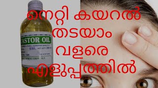 നെറ്റി കയറൽ തടയാം വളരെ എളുപ്പത്തിൽ  Netti Kayaral thadayam  Prevent Hair Fall From Forehead [upl. by Anazus]