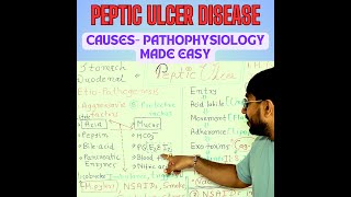 Peptic Ulcer Disease Unveiled How Ulcers Form amp Progress  Pathogenesis Explained [upl. by Jaret]