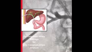 PTBD Treatment in Hyderabad  DR Suresh Giragani [upl. by Clarissa]