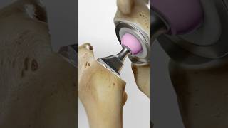 Total hip replacement explained 3D Animation [upl. by Tymes649]