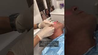 What is Endolift  Skin tightening non surgical facelift treatment [upl. by Mears]