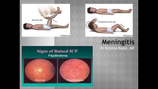 Meningitis [upl. by Niatsirk669]