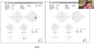 Glaucoma Clinical Case Conversations [upl. by Elroy]