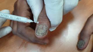 Demo18 Intramatrix injection of triamcinolone for nail disorders [upl. by Eenitsed]