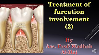 46 Periodontal surgery14 Furcation involvement2Dr Wadhah Periodontology lecturesد وضاح الحاج [upl. by Sender]