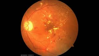 Fundoscopic images of Diabetic Retinopathy [upl. by Spanjian]