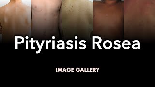 Pityriasis Rosea Image Gallery [upl. by Maller]