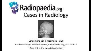 Langerhans cell histiocytosis  skull Radiopaediaorg Cases in Radiology [upl. by Tuneberg]