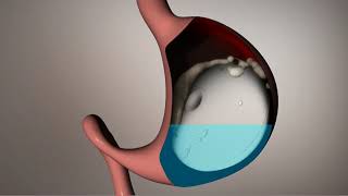 The Allurion Swallowable Gastric Balloon  How it works [upl. by Frye893]