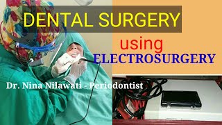 ELECTROSURGERY For Dental Surgeries [upl. by Kristen577]