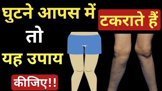 Knock Knee Problem Solution  knock knee कैसे ठीक करें ✅ knock Knees workout  desi gym fitness [upl. by Niwdla]