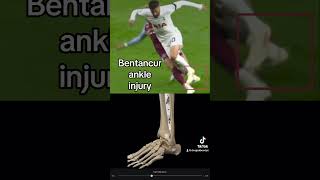 Rodrigo Bentancur ankle injury Expert explains  tottenham thfc premierleague epl football [upl. by Garcia]