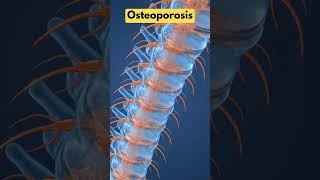 Osteoporosis Prevention Building Stronger Bones After 50 [upl. by Gonagle]