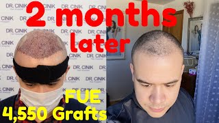 2 Months After My FUE Hair Transplant in Turkey  4550 Grafts  Cinik Clinic [upl. by Valentin]