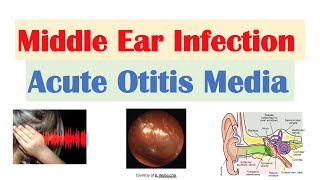 Middle Ear Infection Acute Otitis Media  Causes Symptoms Diagnosis Treatment [upl. by Aloap]