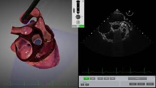 HeartWorks Mechanical Aortic Valve [upl. by Eugilegna780]