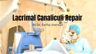 Lacrimal Canaliculi Repair [upl. by Esela]