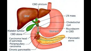 Obstructive jaundice  How to present case  surgery clinics [upl. by Devland108]