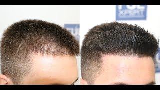 FUE Hair Transplant Repair 705 Grafts By Dr Juan Couto  FUEXPERT CLINIC Madrid Spain [upl. by Lac]