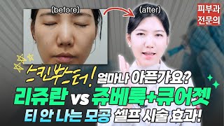 리쥬란 vs 쥬베룩큐어젯 통증 비교 스킨부스터 셀프 시술 전후🫶ㅣ노남경의 피부클래스 [upl. by Niraj]