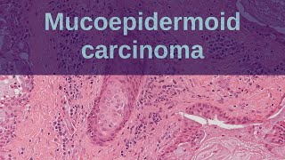 Mucoepidermoid Carcinoma of Salivary Glands  Pathology mini tutorial [upl. by Don175]