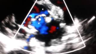 Echocardiogram  periprosthetic reflux leak in bioprosthetic mitral [upl. by Heron906]