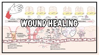 Wound Healing  Stages of healing and pathology [upl. by Derej]