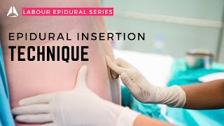 The Epidural Insertion  anesthesiology anesthesia analgesia epidural [upl. by Nam160]